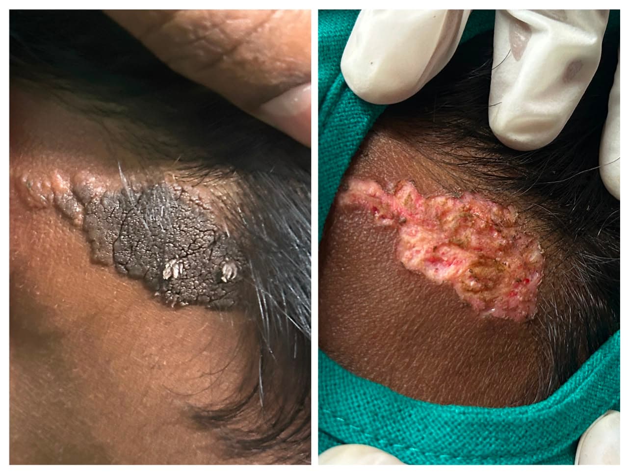 Verrucous Lesion