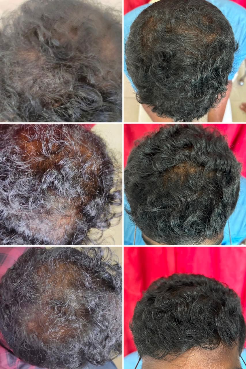 Crown & Mid-Scalp Diffuse Thinning