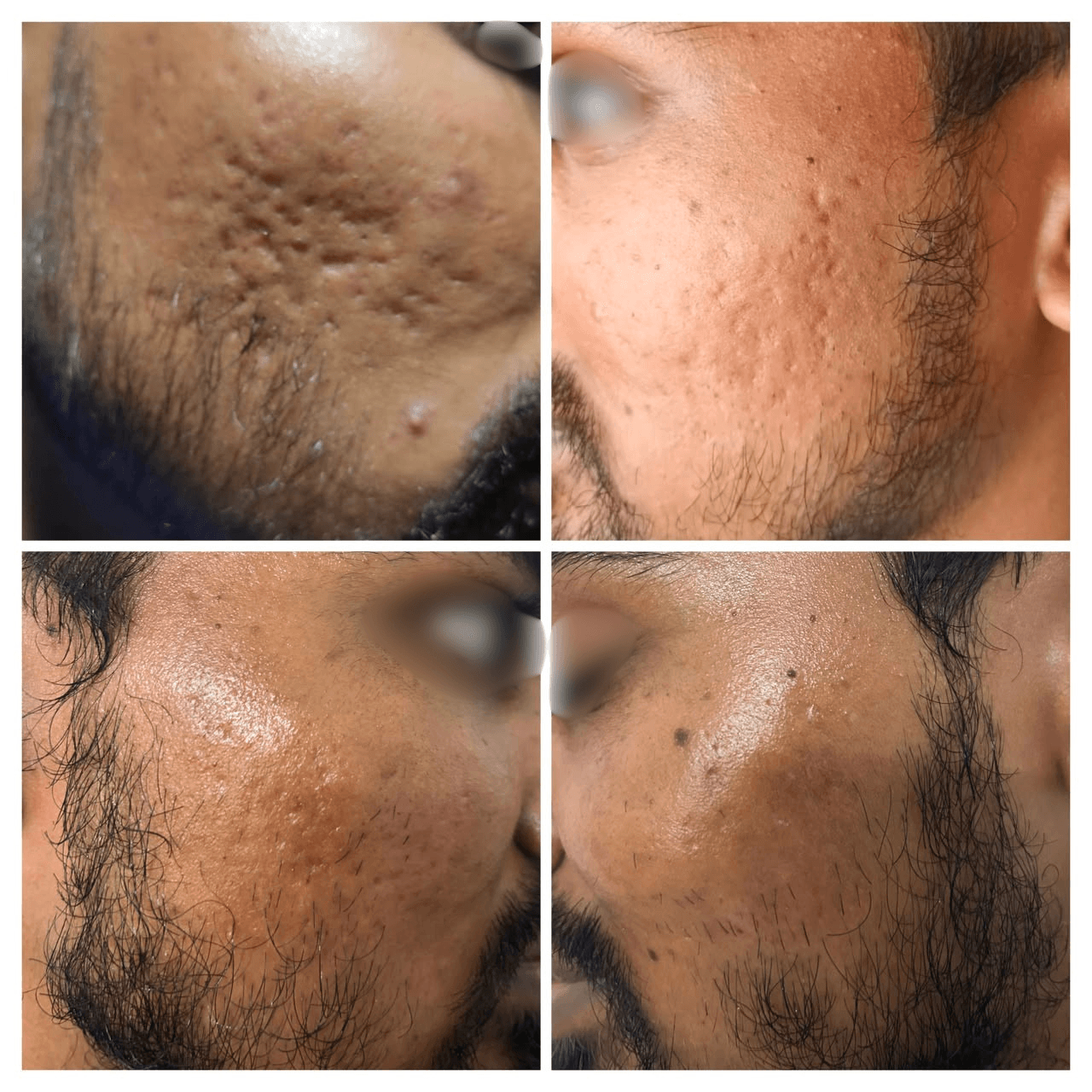 Atrophic Acne Scars & Post-Acne Erythema