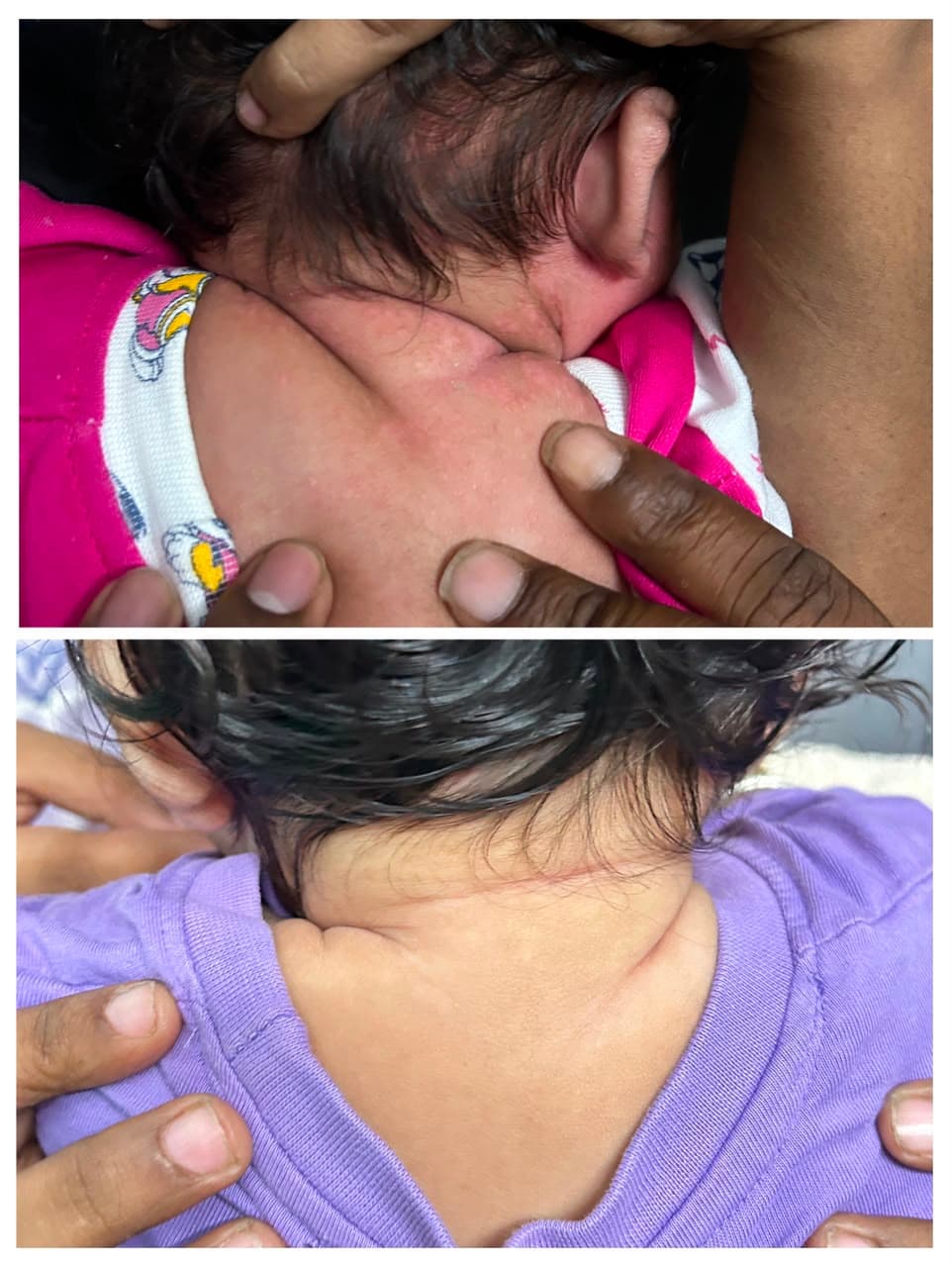 Nuchal Dermatitis / Skin Allergy